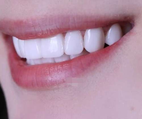 树脂牙齿贴面怎么可以卸掉？可以参考这4个步骤！