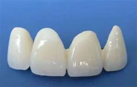 烤瓷牙与全瓷牙：哪种更适合你的牙齿修复？