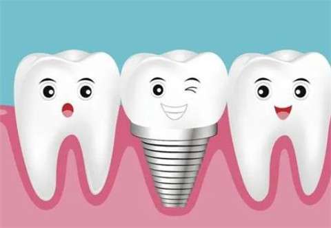 种牙VS镶牙：优缺点全解析，助你做出明智选择！