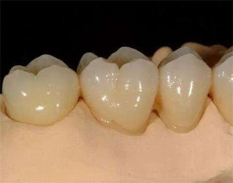 全瓷牙与烤瓷牙：材料、强度与适用性的比较