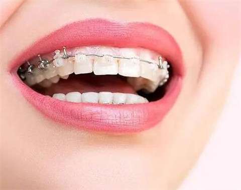 牙缝大怎么办？四种方法让你轻松拥有完美笑容！