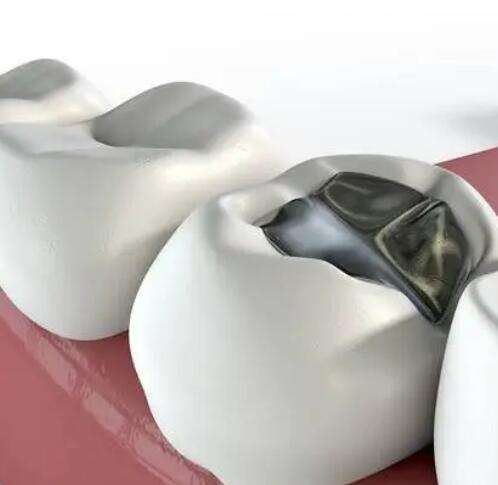 树脂补牙的优缺点、适应症及详细治疗流程全解析