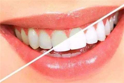 牙齿有缝怎么办？四种修复方法大揭秘！