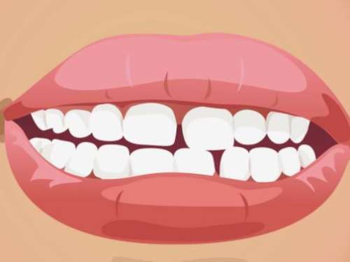 牙缝大影响美观？快来试试这4种修复方法，让你瞬间变身微笑达人！