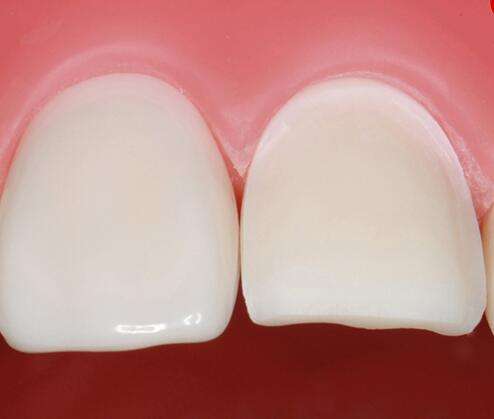 牙齿美容新趋势：贴面备牙，让你快速拥有洁白整齐的牙齿！