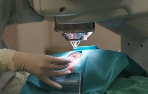 近视手术有哪几种手术方式？